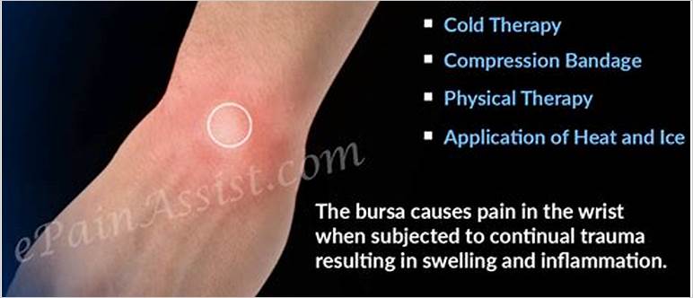 Bursitis wrist pain
